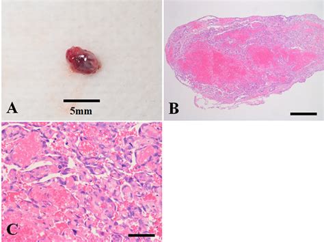 Photographs of the intradural extramedullary tumor. (A) Macroscopic... | Download Scientific Diagram