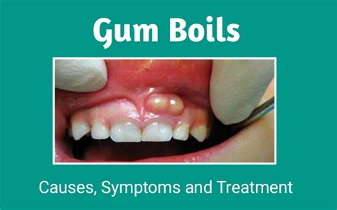 What is Gum Boil? | Symptoms, Causes and Treatment of Gum Boils