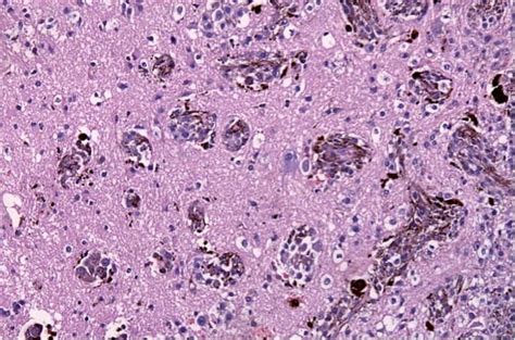 New insights into melanoma brain metastases – BioNews Central