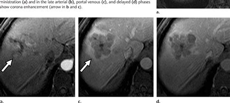 Figure 1 from LI-RADS Version 2018 Ancillary Features at MRI. | Semantic Scholar