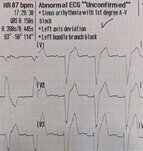 Trifascicular Block : r/EKGs