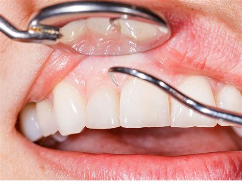 Deep Cleaning | Gums Cleaning in Delray Beach