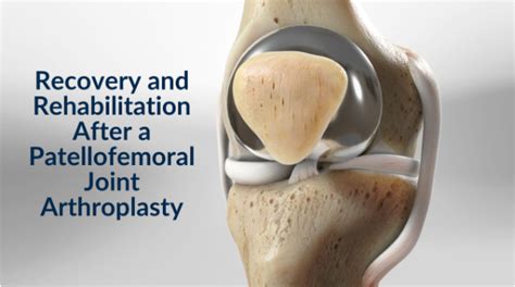 Patellofemoral Joint Arthroplasty - Dr. Paul Norio Morton, MD, FAAOS, FAAHKS