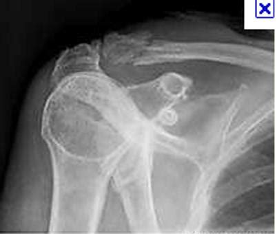 Clavicle Fractures - Distal - Trauma - Orthobullets