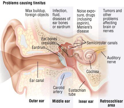 Tinnitus Guide: Causes, Symptoms and Treatment Options