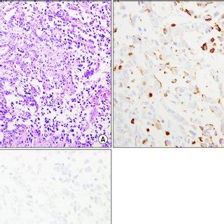 Histopathological findings of the thymic tumor for the diagnosis of... | Download Scientific Diagram