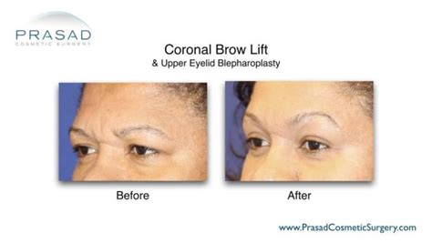 Brow Lift Before and After Photos | Manhattan and Long Island NY