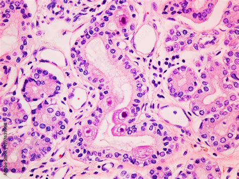 Cytomegalovirus CMV infection in the salivary gland viewed at 400x ...