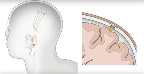 Musk's Neuralink brain chip could add a layer of 'Super-Intelligence'