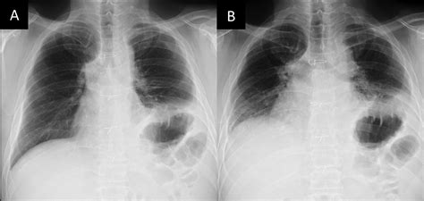 Phrenic Nerve Reconstruction and Bilateral Diaphragm Plication After ...