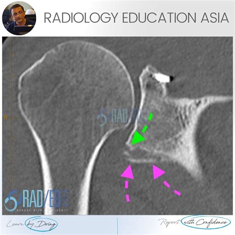 SHOULDER DISLOCATION BONY BANKART GLENOID FRACTURE XRAY CT (VIDEO) - Radedasia