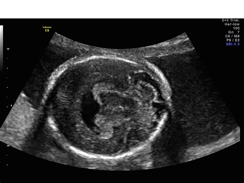 Holoprosencephaly | Obstetrics & Gynecology