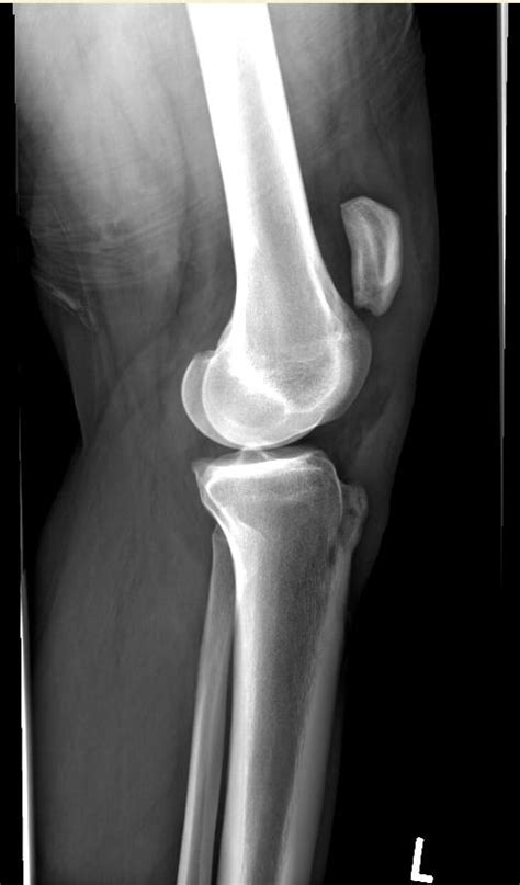 Patellar tendon rupture - wikidoc