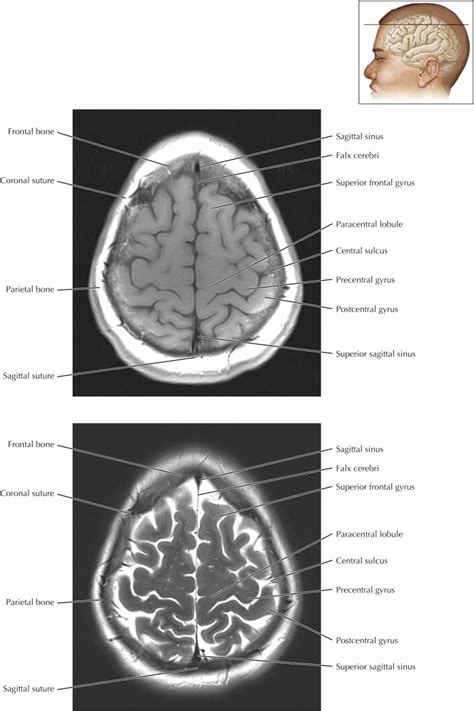 Paracentral Lobule Mri