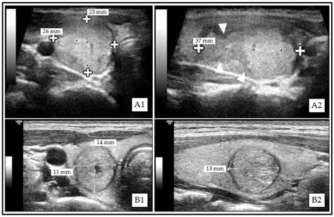 Cancers | Free Full-Text | Diagnostic Performance of Kwak, EU, ACR, and Korean TIRADS as Well as ...