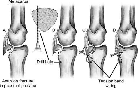 NBA Injury Update: Raul Neto 's fractured finger is . . . healing ...