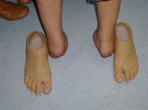 Partial Foot Prosthesis - View Specifications & Details of Prostheses by Synergy REHABILITATION ...