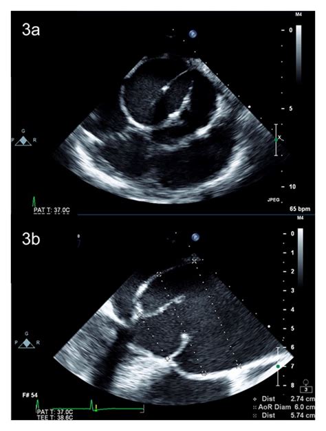 (a) Transesophageal echocardiogram demonstrating a bicuspid aortic ...