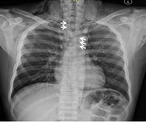 Cureus | Spontaneous Pneumomediastinum in a Young Adult: A Rare Presentation