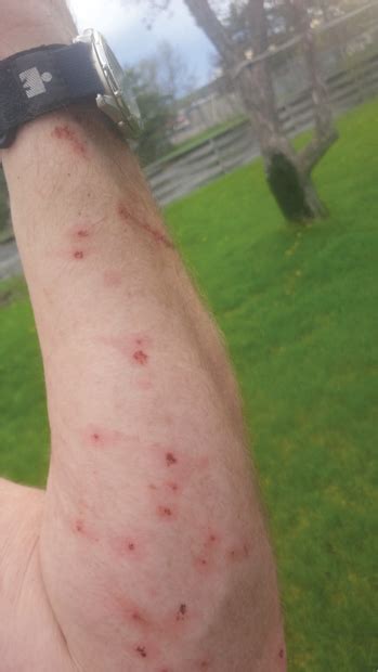 blackfly bites - Northern Wilds Magazine