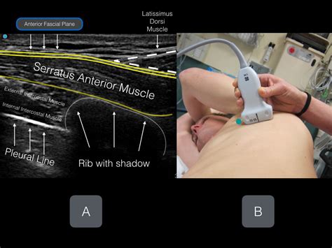 Serratus Anterior Plane (EASY) — Highland EM Ultrasound Fueled pain ...