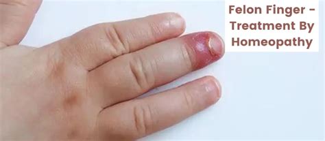 Felon Finger Infection - Causes & Treatment by Homeopathy