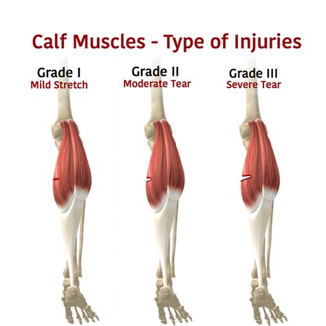 Calf Strain - Motus Physical Therapy