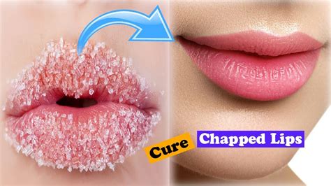 How to Cure Chapped Dry Lips In 5 Minutes - YouTube