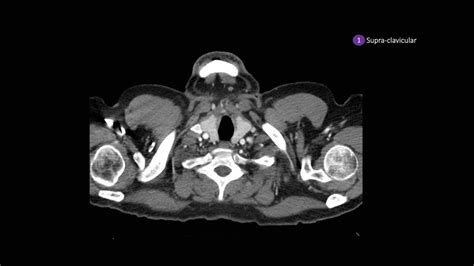 The Radiology Assistant : Mediastinal Lymph Node Map (2023)