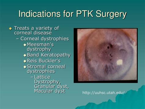 PPT - Phototherapeutic Keratectomy PowerPoint Presentation - ID:3356703