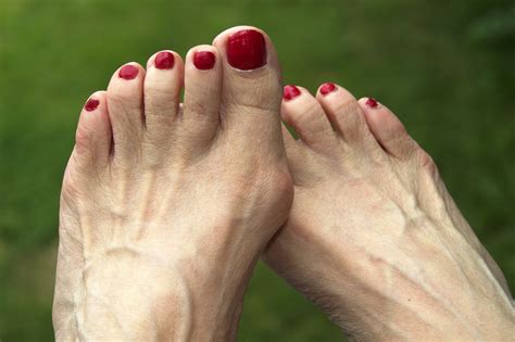 Bunion Surgery: Preparation, Recovery, Long-Term Care