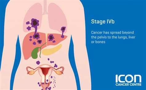 Cervical Cancer Stages