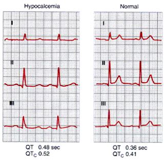 Acute Hypocalcemia - Anesthesia Morbidity and Mortality