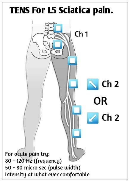 Electrode placement and settings for TENS that I found useful for L5 S1 ...