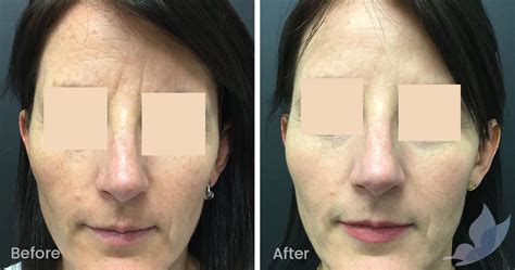 Fine Lines and Wrinkles Before and After Gallery - Austin Clinic