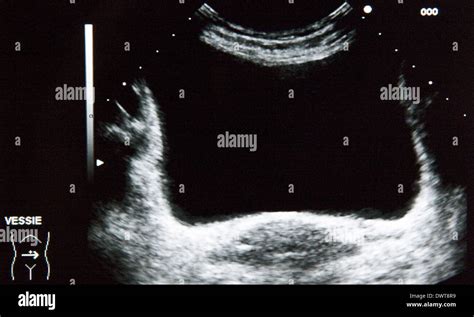 Bladder ultrasound scan Stock Photo - Alamy