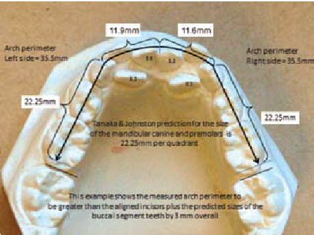 In this example of a Mixed Dentition Space Analysis, the Tanaka and... | Download Scientific Diagram