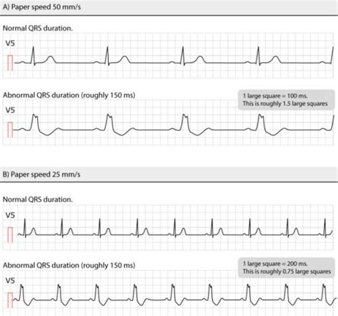 The QRS complex: ECG features of the Q-wave, R-wave, S-wave & duration