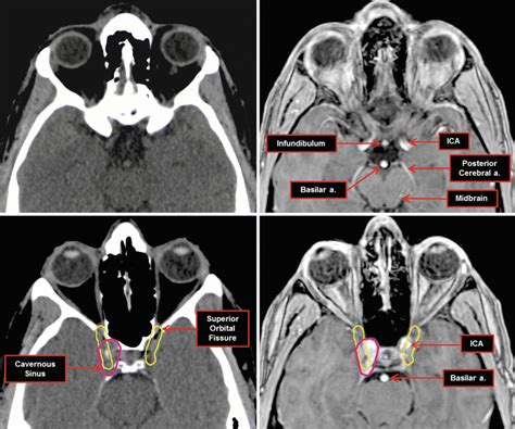 Nerves | Radiology Key