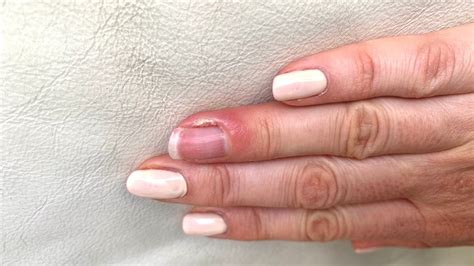 Infected cuticles: causes and the best treatment for cuticle damage