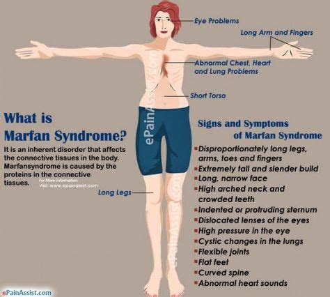 What is Marfan Syndrome? #medical #medical #facts in 2020 | Marfan syndrome, Syndrome, Genetic ...