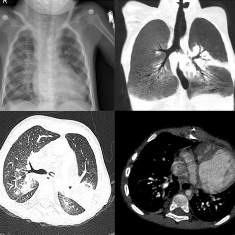 A. Chest X-ray with perihilar congestion and bilateral basal... | Download Scientific Diagram