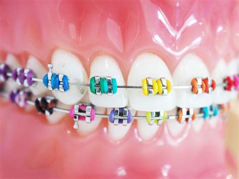 Metal Braces Treatment in Lawrenceville, Loganville, Morrow, Stone Mountain, GA