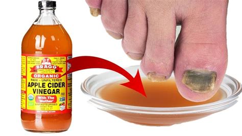 How To Use Apple Cider Vinegar For Toenail Fungus? | Its Charming Time