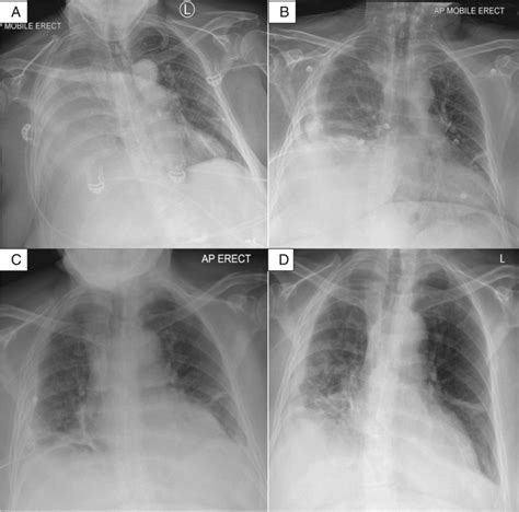 Progression of empyema on chest X-rays (CXRs) from admission to end of... | Download Scientific ...