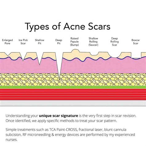 Tixel Resurfacing For Acne Scars - Dr Davin Lim