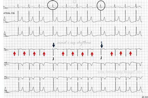 ECG Rhythms: SR, Second Degree AV Block Type I, Junctional Escape Beats