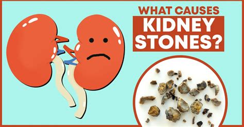 What Causes Kidney Stones? How Can You Decrease Your Risk of Kidney Stones? - Williams ...