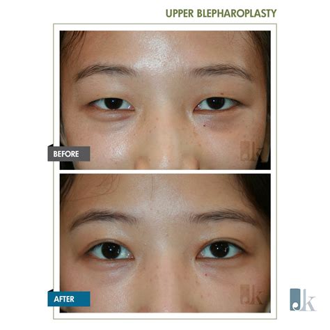 Asian Double Eyelid - John Kang MD F.A.C.S :: JK Facial Plastics & Reconstructive