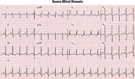 Mitral Valve Stenosis Ecg